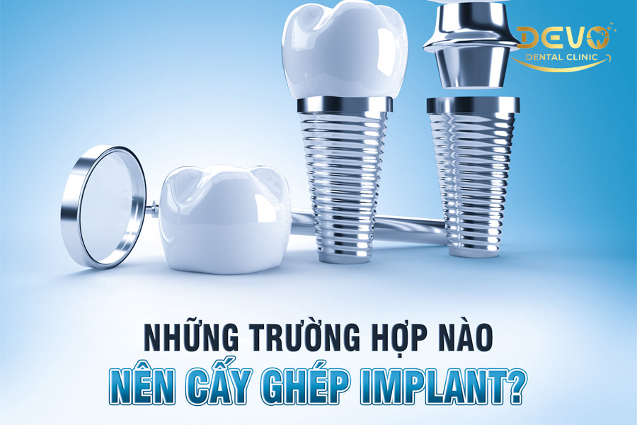 cac truong hop cay implant
