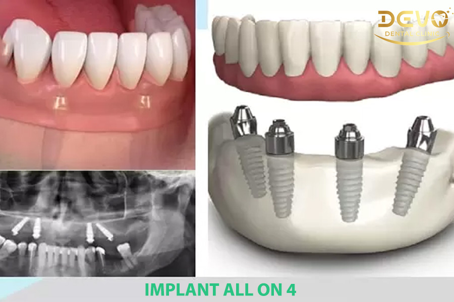 cay ghep implant all on 4