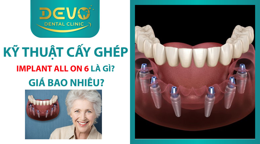 cay ghep implant all on 6