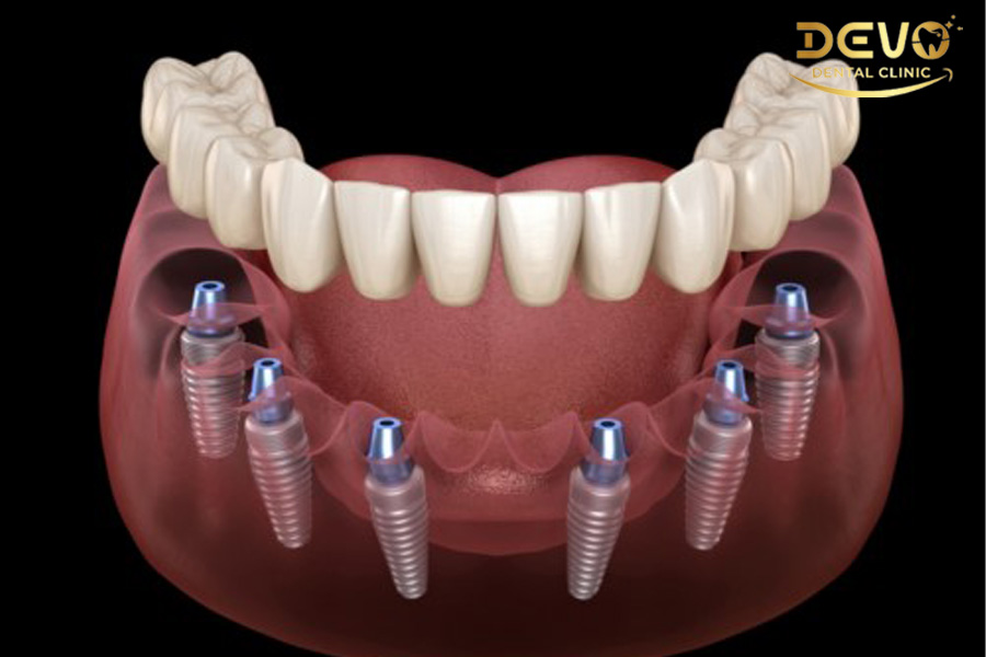 cay ghep implant all on 6