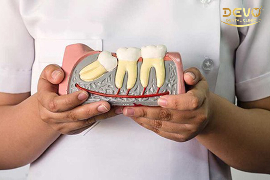 Răng khôn là gì? Thời điểm nào nên nhổ răng khôn