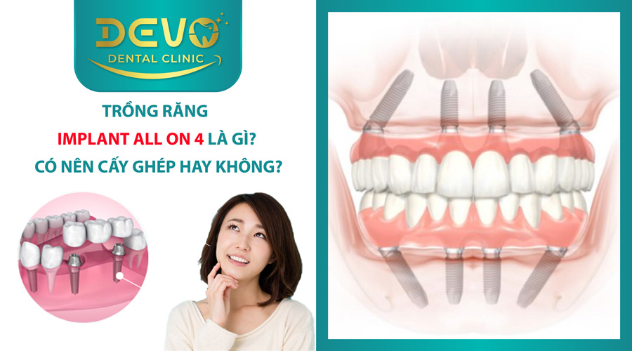 trong răng implant all on 4 tot nhat