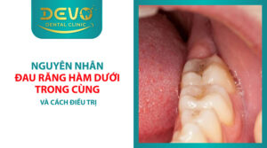 nguyen nhan dau rang ham duoi trong cung