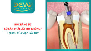 boc rang su co can lay tuy khong