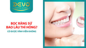 Bọc răng sứ bao lâu thì hỏng