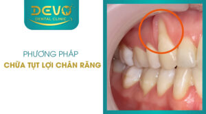 chua-tut-loi-chan-rang