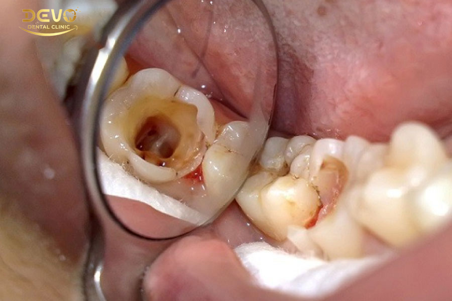 Những răng cần điều trị tủy