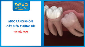 mọc răng khôn gây biến chứng gì