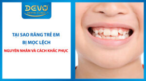 rang tre em bi moc lech
