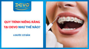 Quy trình niềng răng tại Devo