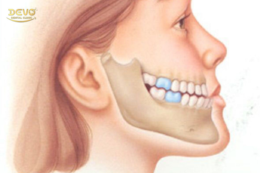 Răng móm là gì