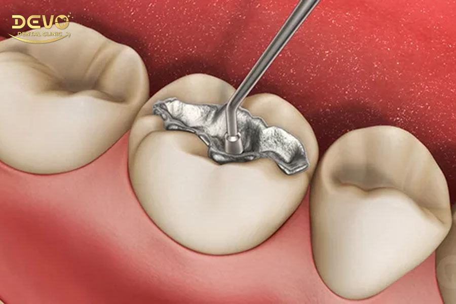 Trị nhức răng bằng phương pháp hàn tràm tại nha khoa