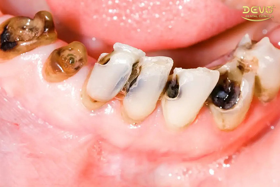 Điều trị phục hình cho răng bị sâu vỡ